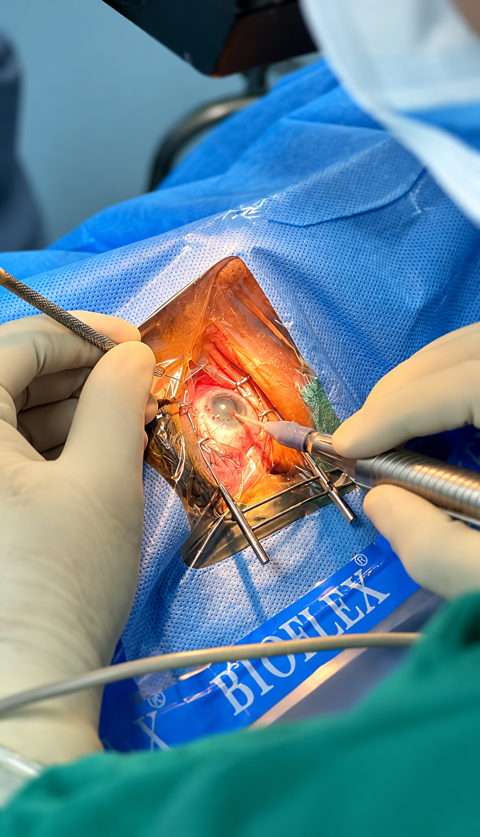 Close view of an ophthalmic procedure under a surgical microscope